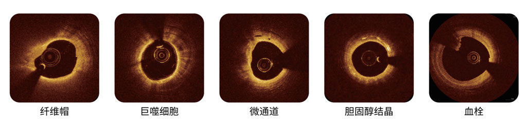 辨識(shí)動(dòng)脈細(xì)微結(jié)構(gòu)