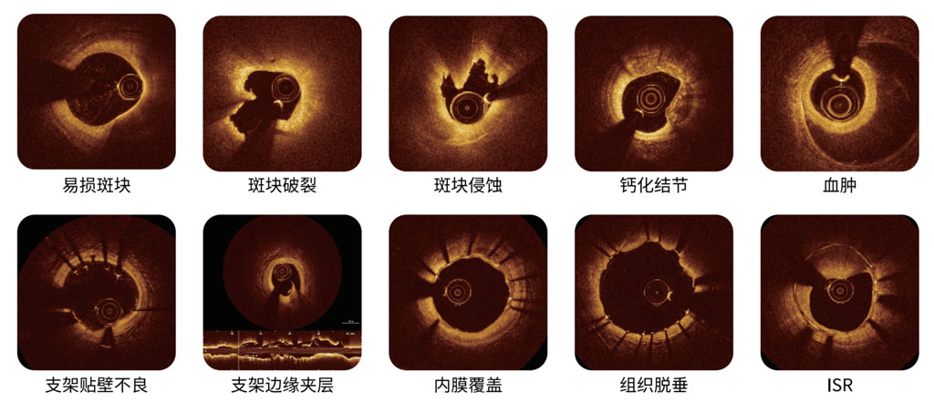 精確鑒別診斷，優(yōu)化介入治療策略
